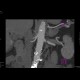 Stenosis of renal artery: CT - Computed tomography